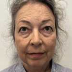Facelift Before & After Patient #1607