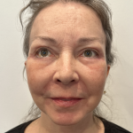 Facelift Before & After Patient #1607