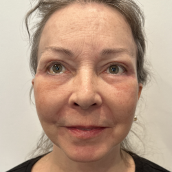 Facelift Before & After Patient #1607