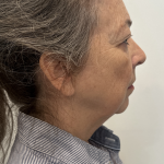 Facelift Before & After Patient #1607