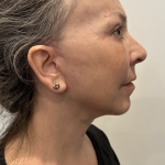 Facelift Before & After Patient #1607