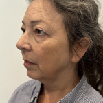 Facelift Before & After Patient #1607
