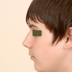 Rhinoplasty Before & After Patient #1040