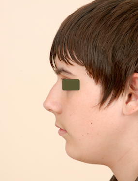 Rhinoplasty Before & After Patient #1040