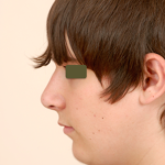 Rhinoplasty Before & After Patient #1040