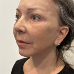 Facelift Before & After Patient #1607