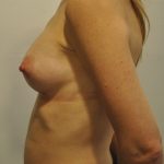 Breast Augmentation Before & After Patient #404