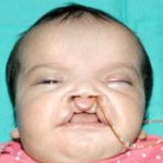 Cleft lip and palate Before & After Patient #1572