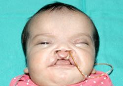 Cleft lip and palate Before & After Patient #1572