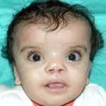 Cleft lip and palate Before & After Patient #1572