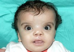 Cleft lip and palate Before & After Patient #1572