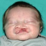 Cleft lip and palate Before & After Patient #1573