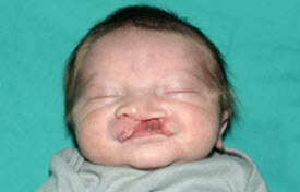 Cleft lip and palate Before & After Patient #1573