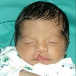 Cleft lip and palate Before & After Patient #1574
