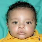 Cleft lip and palate Before & After Patient #1574
