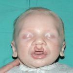 Cleft lip and palate Before & After Patient #1575