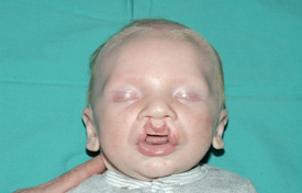 Cleft lip and palate Before & After Patient #1575