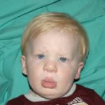 Cleft lip and palate Before & After Patient #1575