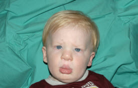 Cleft lip and palate Before & After Patient #1575