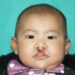 Cleft lip and palate Before & After Patient #1576