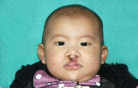 Cleft lip and palate Before & After Patient #1576