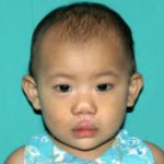 Cleft lip and palate Before & After Patient #1576