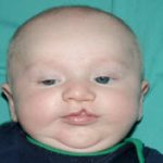 Cleft lip and palate Before & After Patient #1577