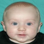 Cleft lip and palate Before & After Patient #1577