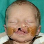 Cleft lip and palate Before & After Patient #1571