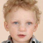 Cleft lip and palate Before & After Patient #1571