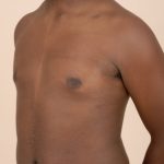 Gynecomastia Before & After Patient #1012