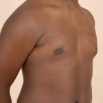 Gynecomastia Before & After Patient #1012