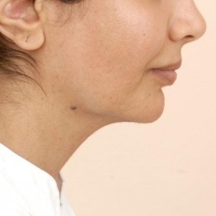 Mandibular Jaw Implants Before & After Patient #1020