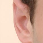 Otoplasty Before & After Patient #947