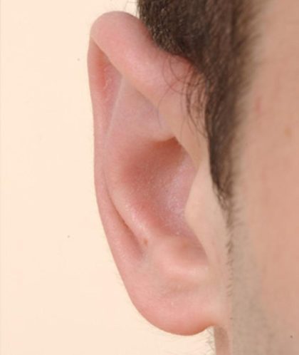 Otoplasty Before & After Patient #947