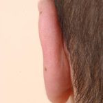 Otoplasty Before & After Patient #947