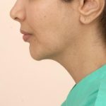 Mandibular Jaw Implants Before & After Patient #1020