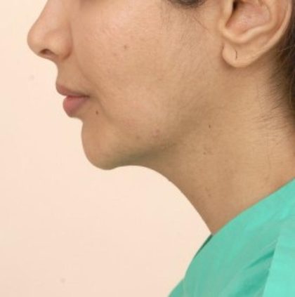 Mandibular Jaw Implants Before & After Patient #1020