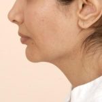 Mandibular Jaw Implants Before & After Patient #1020