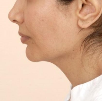 Mandibular Jaw Implants Before & After Patient #1020