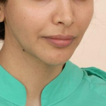 Mandibular Jaw Implants Before & After Patient #1020