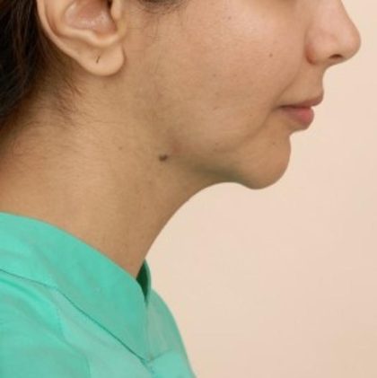 Mandibular Jaw Implants Before & After Patient #1020