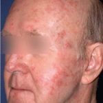 Acne Scars Before & After Patient #1637