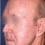 Acne Scars Before & After Patient #1637