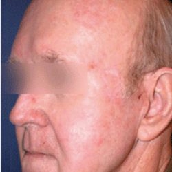 Acne Scars Before & After Patient #1637