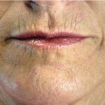 Acne Scars Before & After Patient #1638