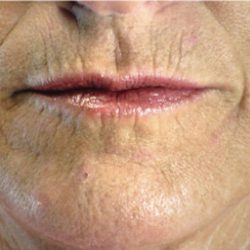 Acne Scars Before & After Patient #1638