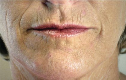 Acne Scars Before & After Patient #1638