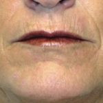 Acne Scars Before & After Patient #1638