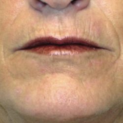 Acne Scars Before & After Patient #1638